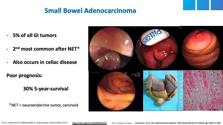 Small Bowel Adenocarcinoma 19 Small Bowel Adenocarcinoma