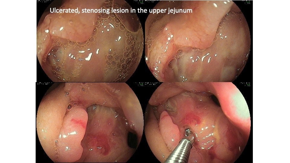 Small Bowel Adenocarcinoma