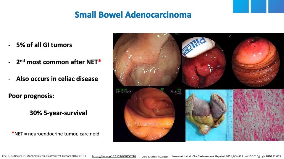 Small Bowel Adenocarcinoma 23 Small Bowel Adenocarcinoma
