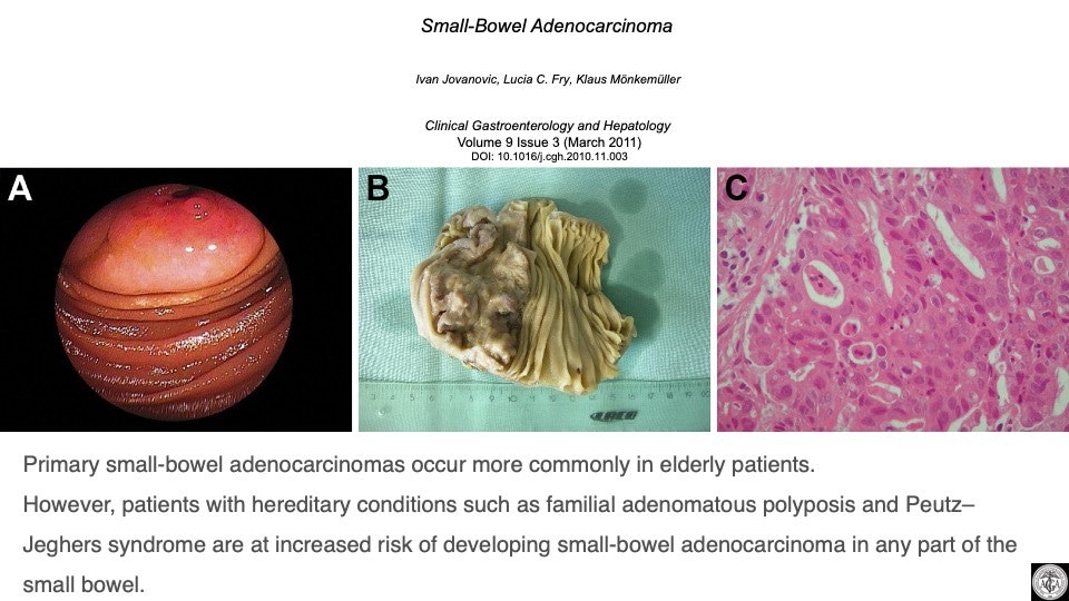 Small Bowel Adenocarcinoma, Part 2 21 Small Bowel Adenocarcinoma, Part 2