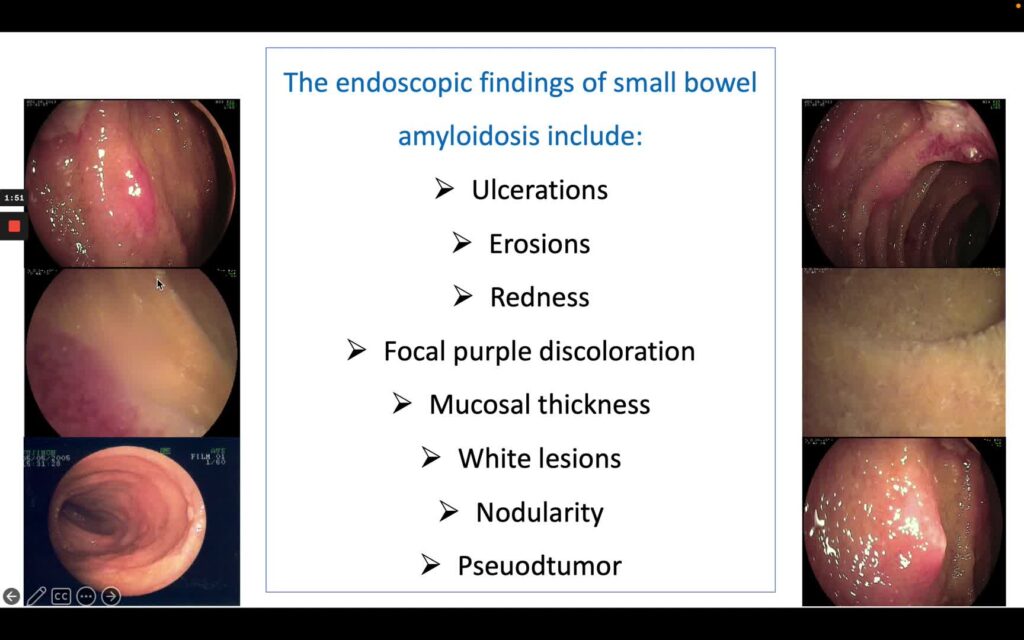 Small Bowel Amyloidosis