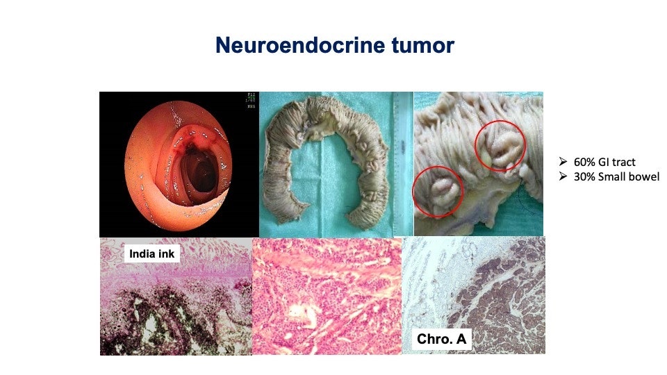 Small Bowel Carcinoid (Net) 19 Small Bowel Carcinoid (Net)
