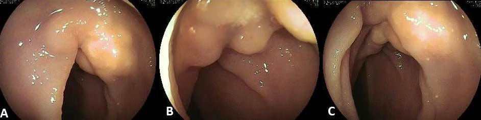 Small Bowel Lymphangioma 17 Small Bowel Lymphangioma