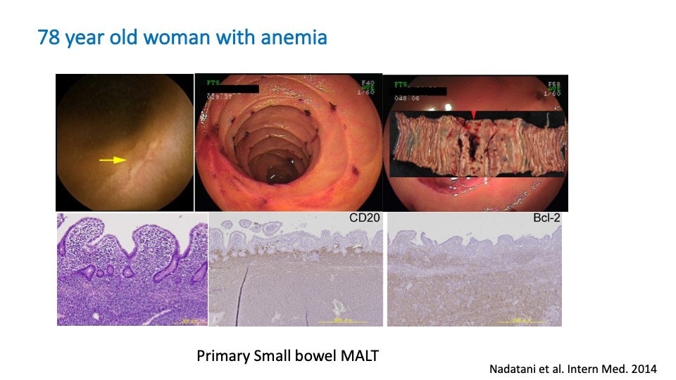 Small Bowel Malt Lymphoma 15 Small Bowel Malt Lymphoma