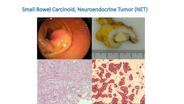 Small Bowel Net 15 Small Bowel Net