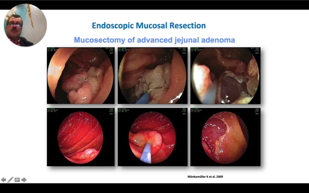 Small Bowel Polypectomy -The Essentials 3 Small Bowel Polypectomy -The Essentials