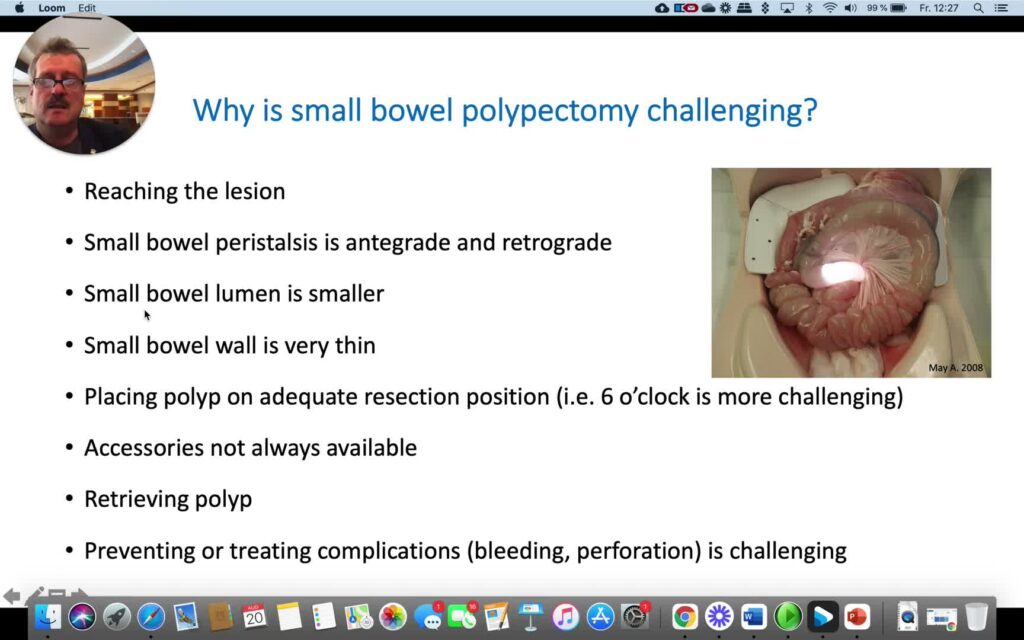 Small Bowel Polypectomy – Tips And Tricks