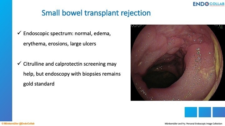 Small Bowel Transplant Rejection 11 Small Bowel Transplant Rejection