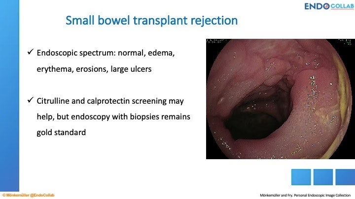 Small Bowel Transplant Rejection 13 Small Bowel Transplant Rejection