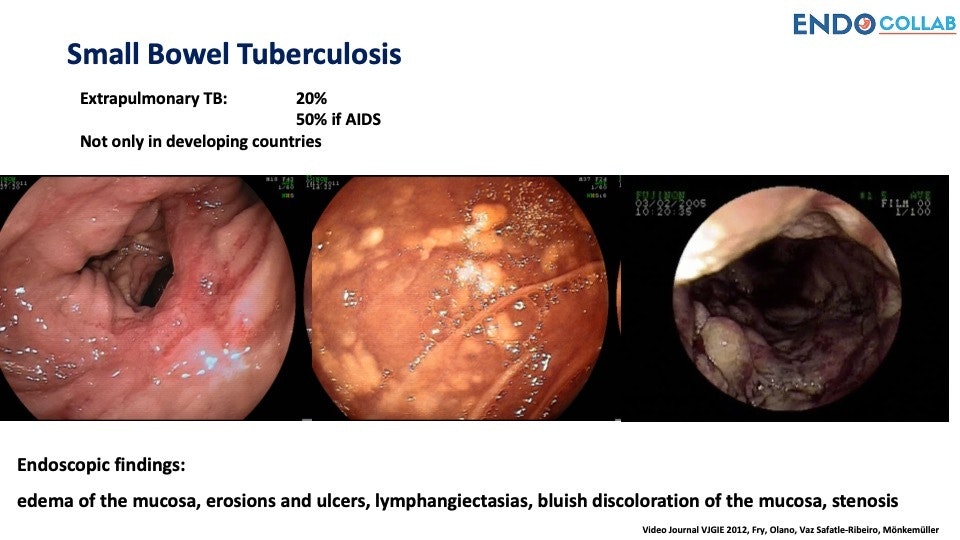 Small Bowel Tuberculosis 9 Small Bowel Tuberculosis