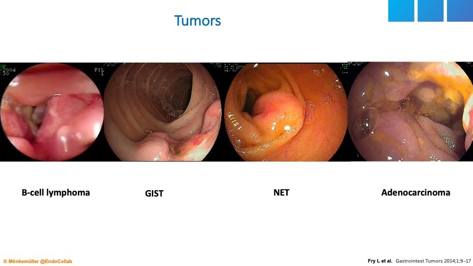Small Bowel Tumors 7 Small Bowel Tumors