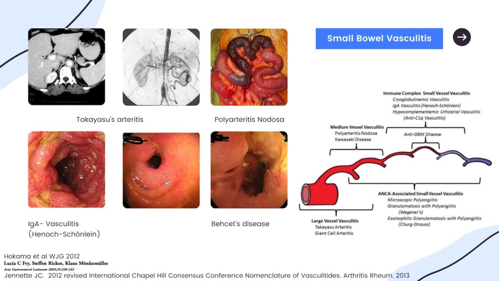 Small Bowel Vasculitis 5 Small Bowel Vasculitis