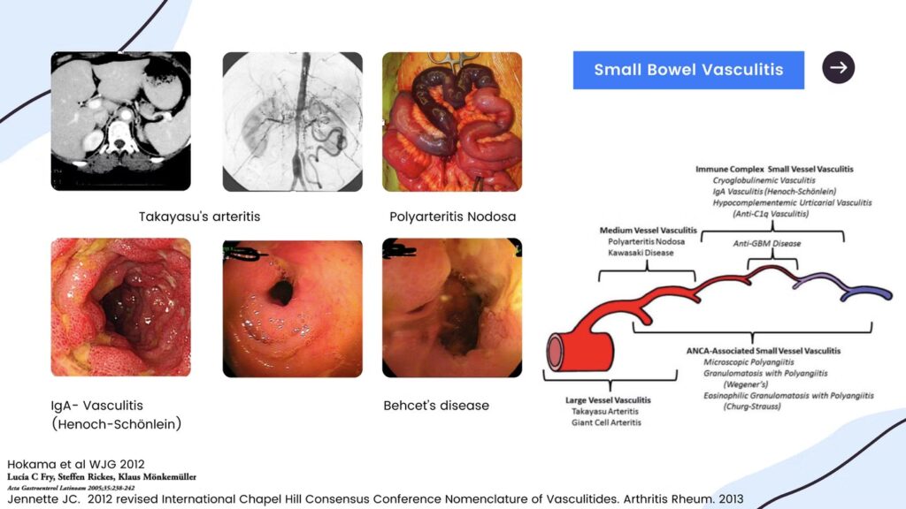 Small Bowel Vasculitis 11 Small Bowel Vasculitis