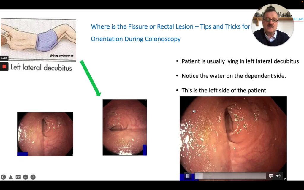 Spatial Orientation During Colonoscopy