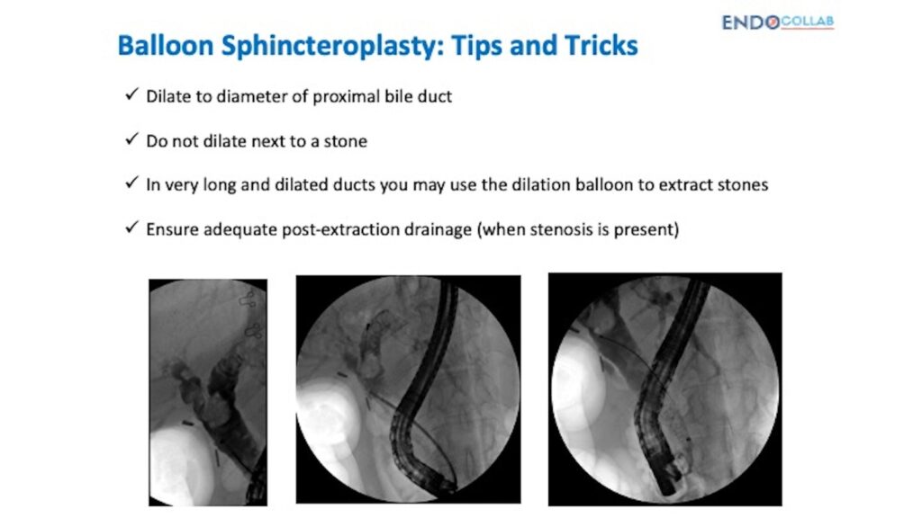 Sphincteroplasty For Stone Extraction - More Tips 7 Sphincteroplasty For Stone Extraction – More Tips