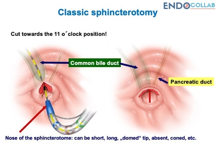 Sphincterotomy - The First Step For Successful Stone Extraction 5 Sphincterotomy – The First Step For Successful Stone Extraction