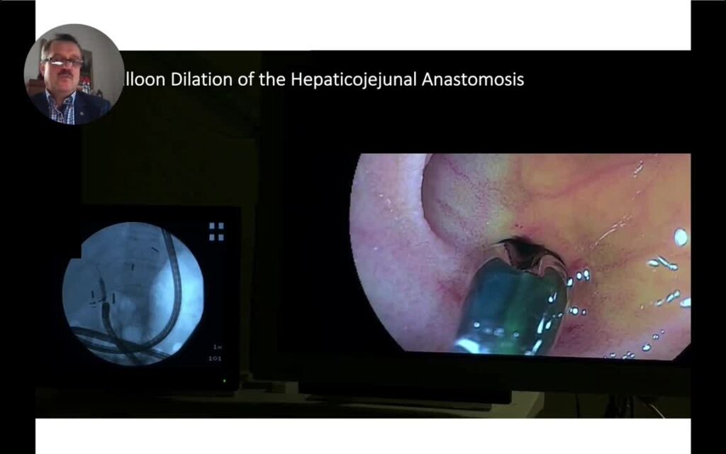 Stent-Pushing-Stent Technique In Dbe-Ercp