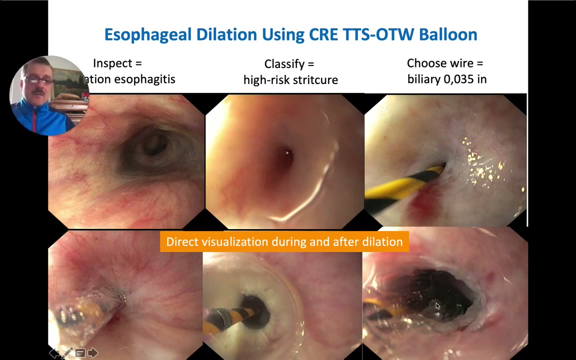 Esophageal Stricture Dilation: Wire Rules, The Flipped Wire Technique, And The Rule Of Three 3 Endoscopic Views Of Cre Balloon Dilation Of A Tight Esophageal Stricture With Direct Visualization During And After Dilation