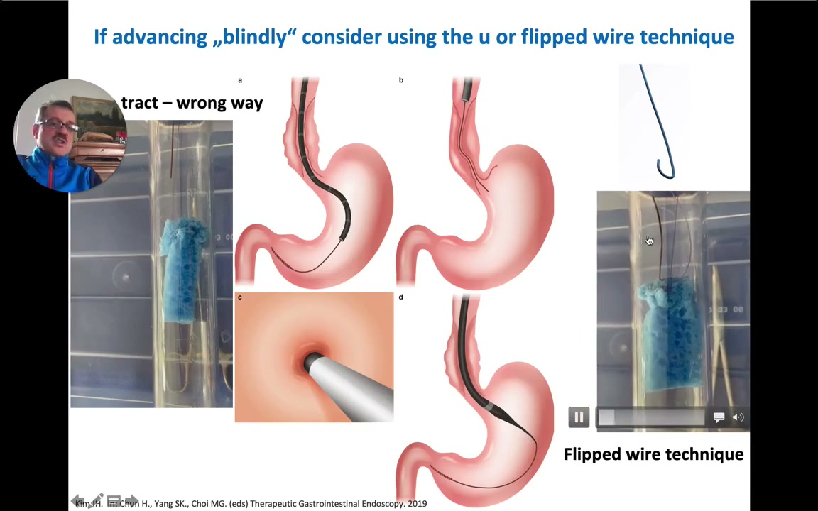 Esophageal Stricture Dilation: Wire Rules, The Flipped Wire Technique, And The Rule Of Three 2 Flipped Wire Technique Slide Showing A False Tract From Blind Wire Advancement And The U-Shaped Wire Tip That Prevents It