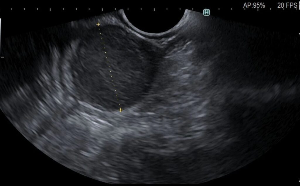 Subepithelial Gastric Lesion - Gist: A Step-By-Step Explanation By Dr. Katarzyna Monika Pawlak 5 Subepithelial Gastric Lesion – Gist: A Step-By-Step Explanation By Dr. Katarzyna Monika Pawlak