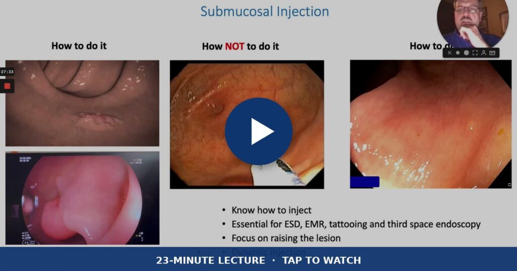 The Submucosal Cushion: Tips And Tricks 9 The Submucosal Cushion: Tips And Tricks — 23-Minute Lecture, Tap To Watch