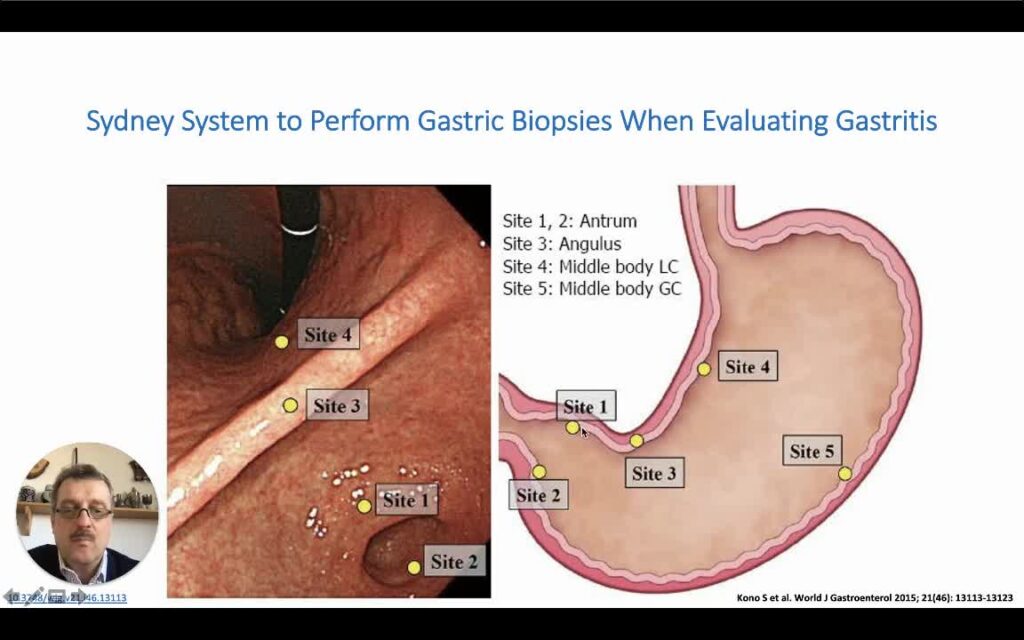 Sydney Protocol for Stomach Biopsies