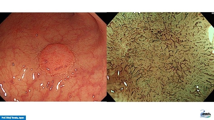 Systematic Approach For The Evaluation Of A 0-Ii A Lesion 15 Systematic Approach For The Evaluation Of A 0-Ii A Lesion