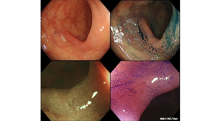 Systematic Approach For The Evaluation Of A Flat Non-Polypoid Lesion 9 Systematic Approach For The Evaluation Of A Flat Non-Polypoid Lesion