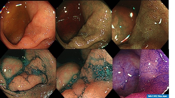 Systematic Approach To Evaluating A Flat 0-Iic Lesion 17 Systematic Approach To Evaluating A Flat 0-Iic Lesion