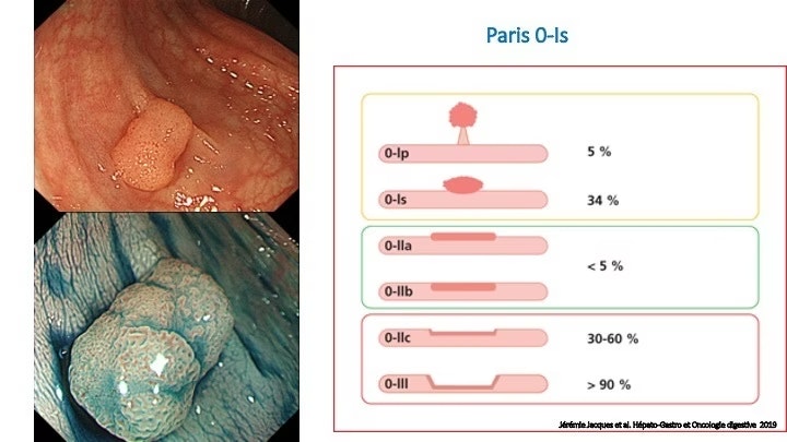 Systematically Evaluating A Sessile Polyp 2 Systematically Evaluating A Sessile Polyp