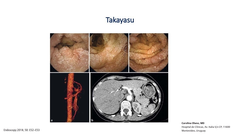 Takayasu'S Arteritis By Prof. Carolina Olano 3 Takayasu’s Arteritis By Prof. Carolina Olano