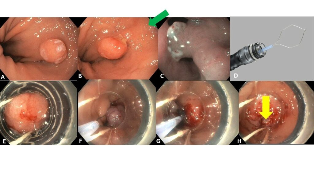 Technical Review: Endoscopic Resection of a Cardia Polyp Inside a Hiatal Hernia Sack Using the Duette Device
