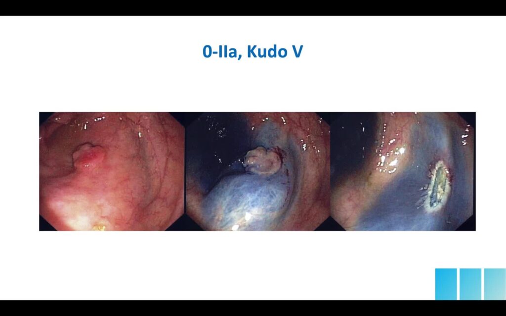 Techniques And Tools To Improve Colorectal Polyp Characterization 10 Techniques And Tools To Improve Colorectal Polyp Characterization