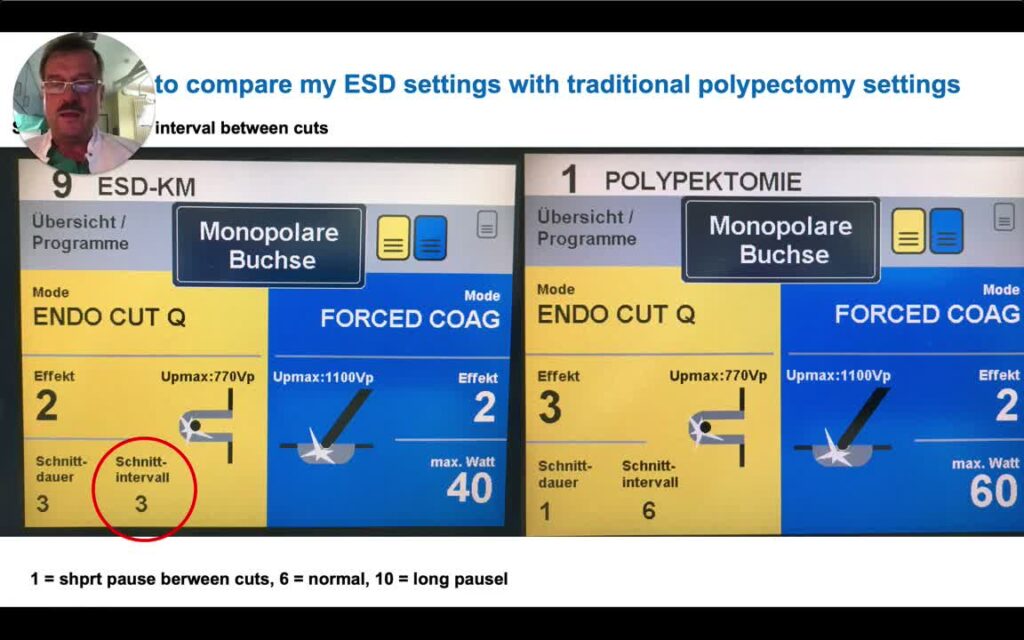 The Concept Of Kar – Knife-Assisted Resection (Esd-Emr Hybrid)