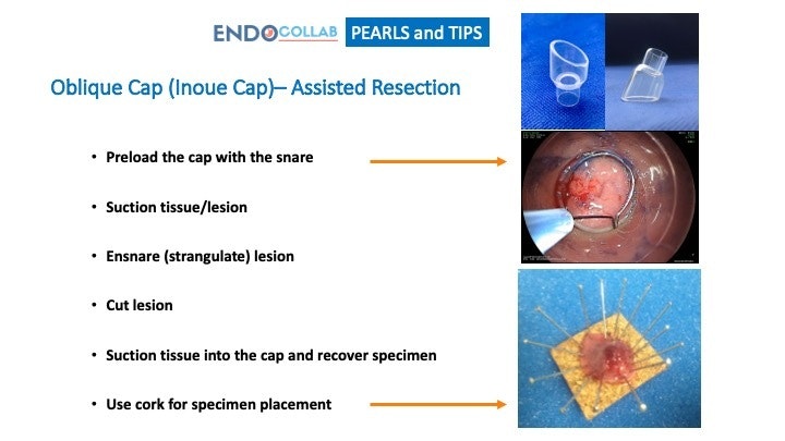 The Inoue Cap – Pearls And Tips