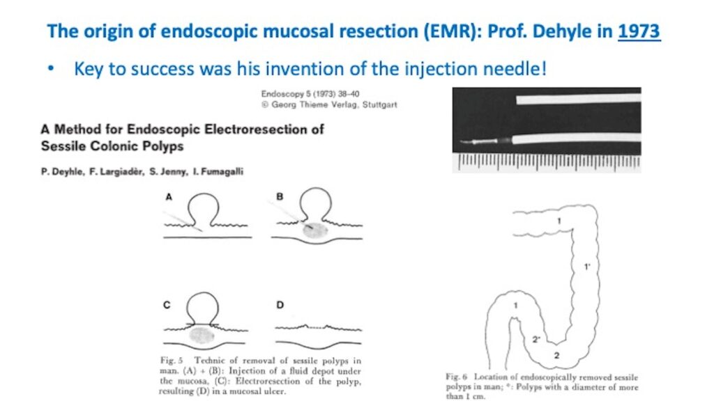 The Origins Of Endoscopic Mucosal Resection (Emr) Date Back To 1973