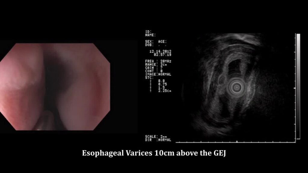 The Palisade Vessels (In The Distal Esophagus) By Dr ≪A≫Roy Soetikno≪/A≫ 8 The Palisade Vessels (In The Distal Esophagus) By Dr Roy Soetikno