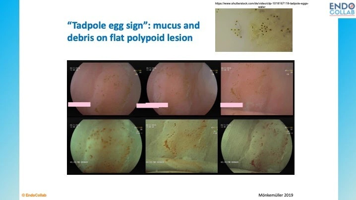 The “Tadpole Egg Sign”