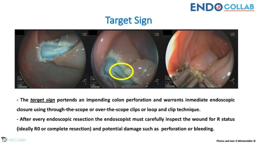 The Target Sign – Recognizing Early Perforation