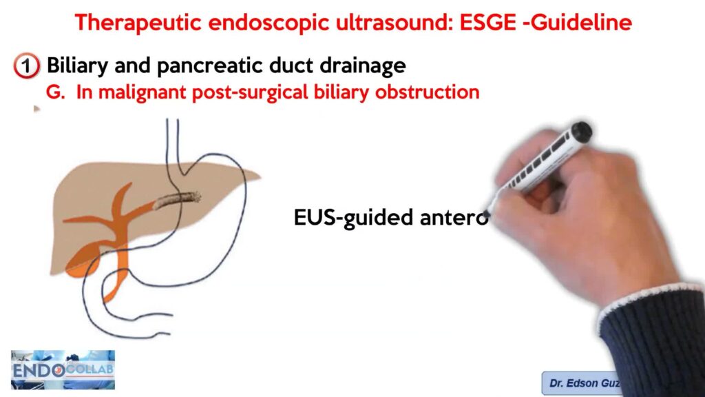Therapeutic Endoscopic Ultrasound: Esge Guideline - 2022 14 Therapeutic Endoscopic Ultrasound: Esge Guideline – 2022