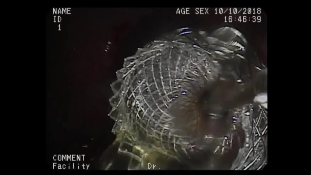 Hot Axios For Psc Drainage Without Eus