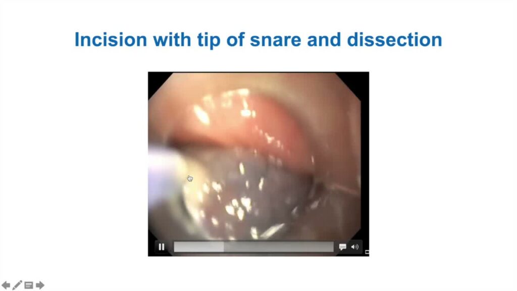 Thinking Outside The Box - Alternative Endoscopic Resection Techniques For Colon Lesions 13 Thinking Outside The Box – Alternative Endoscopic Resection Techniques For Colon Lesions