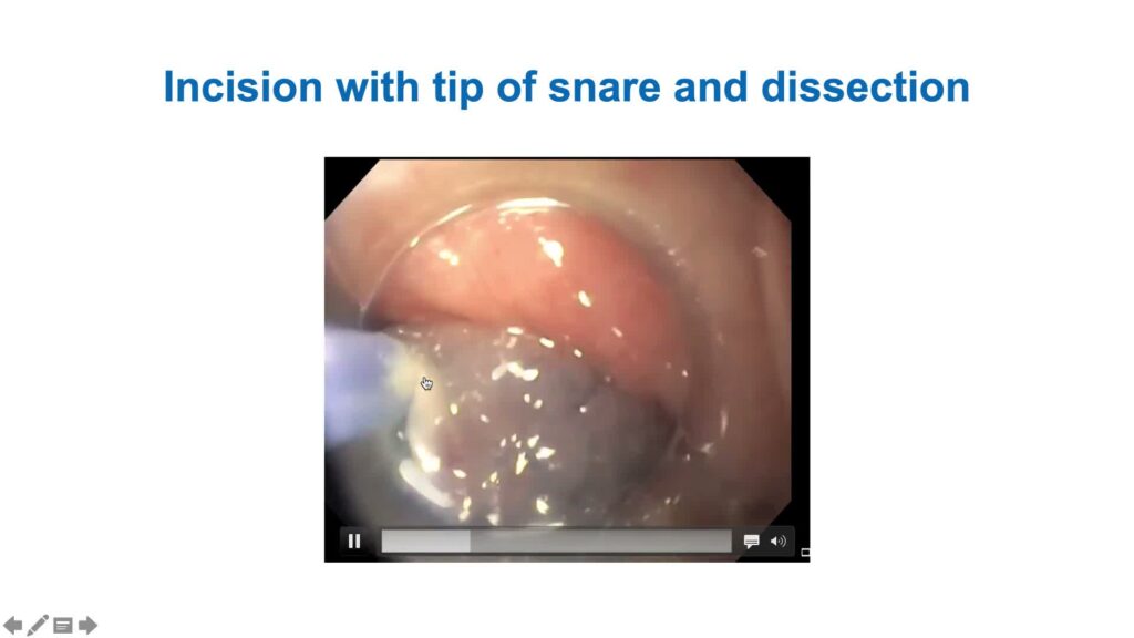 Thinking Outside The Box – Alternative Techniques For Resection Of Colon Polyps