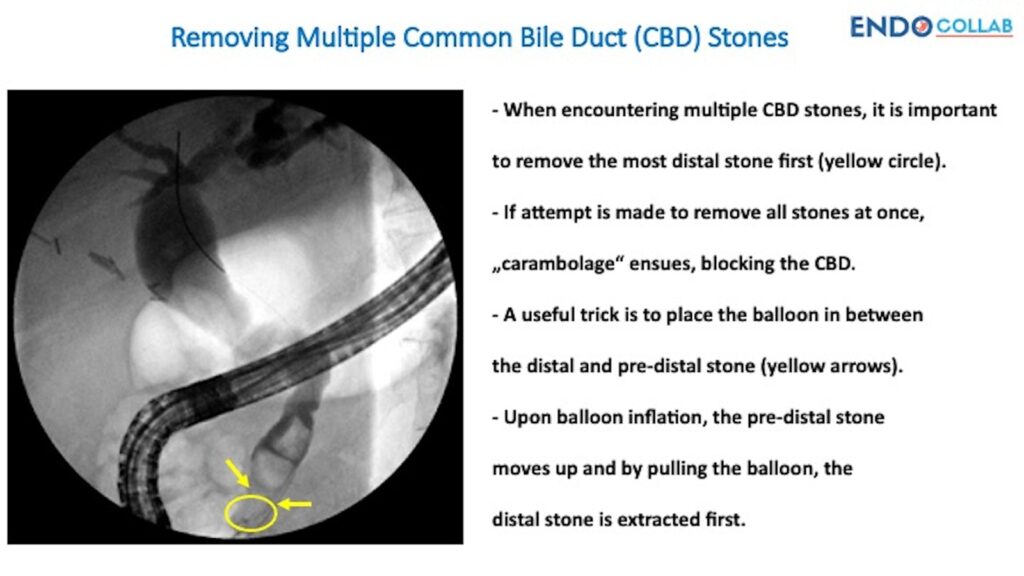 Tip To Safely Remove Multiple Bile Duct Stones 3 Tip To Safely Remove Multiple Bile Duct Stones