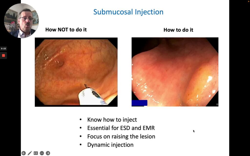 Tips And Tricks For Prevention And Treatment Of Post-Resection Bleeding