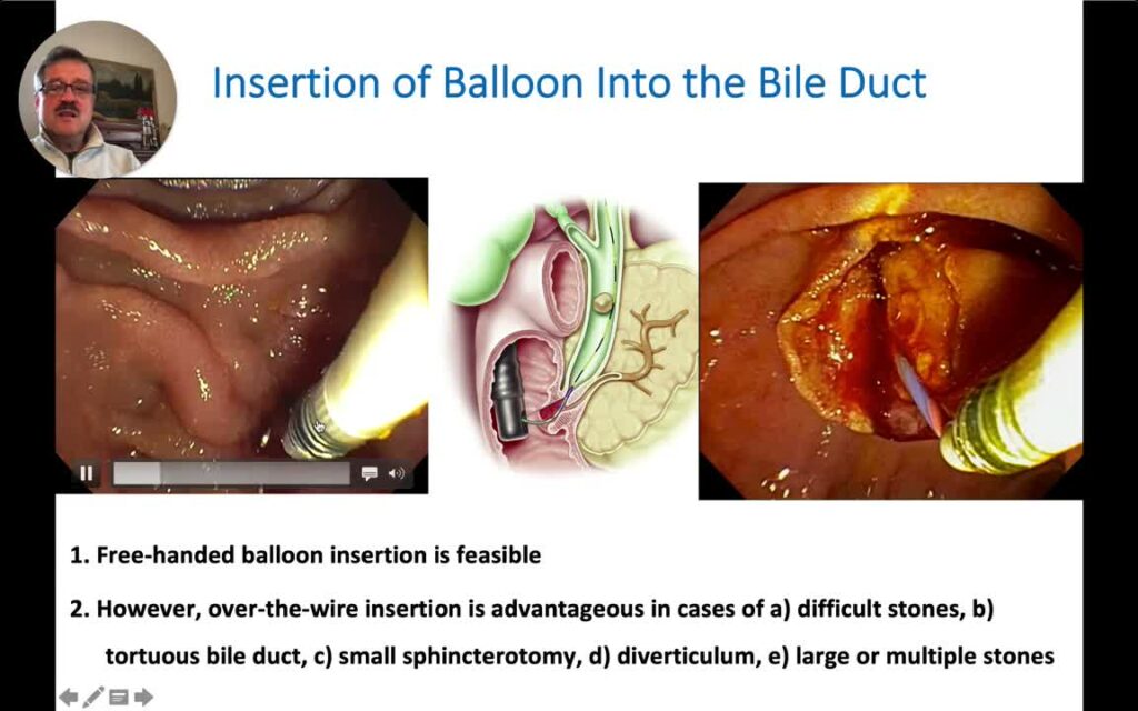 Tips And Tricks On Using The Stone Extraction Balloon