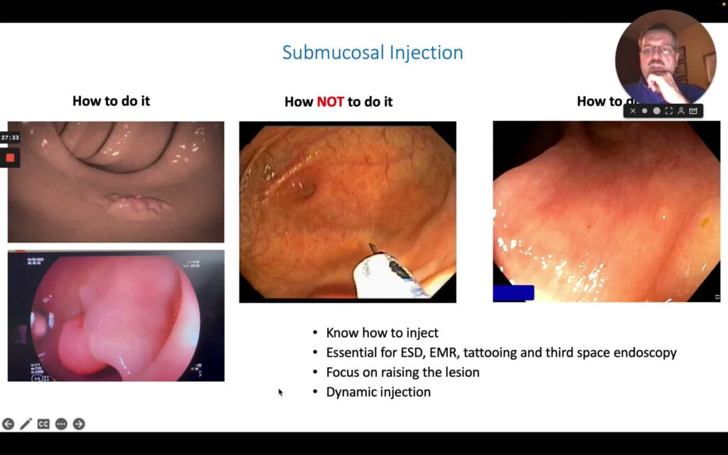 Tips And Tricks To Create The Perfect Submucosal Injection (Cushion)