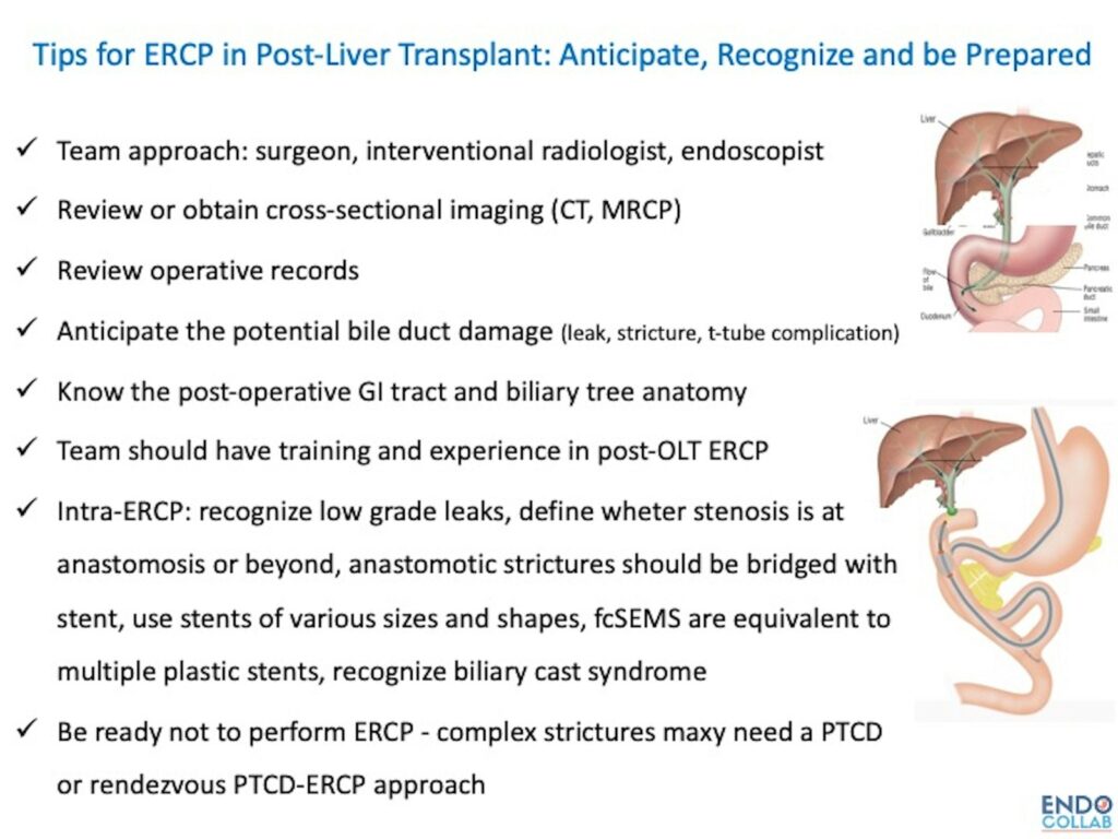 Tips For Ercp In Patients Post Liver Transplant 1 Tips For Ercp In Patients Post Liver Transplant