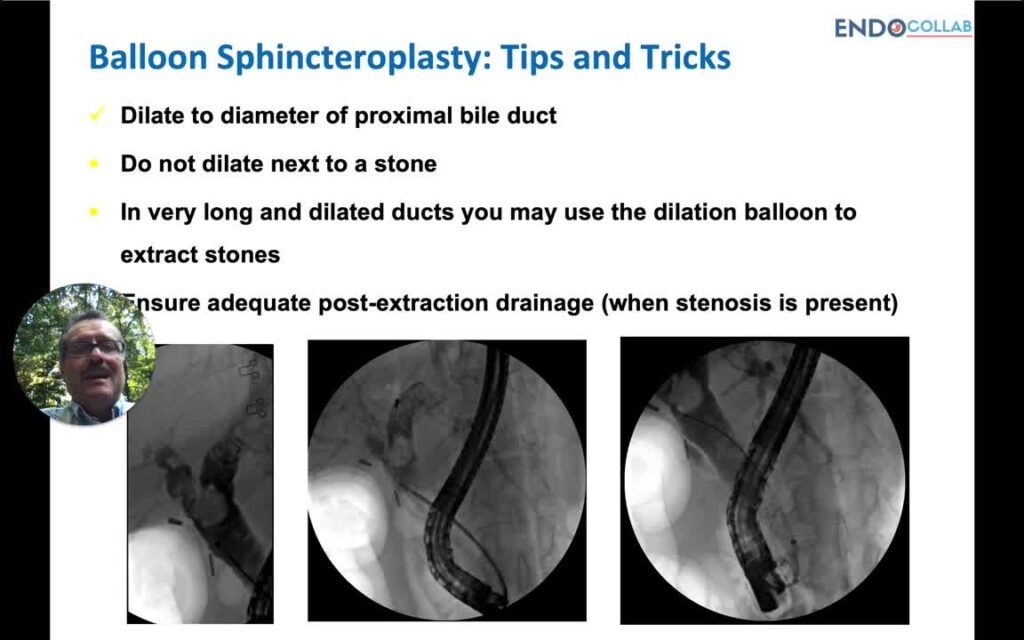 Tips for ERCP-Sphincterotomy: Endoscopic Large Balloon Biliary Sphincteroplasty
