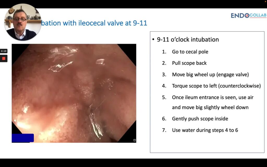 Tips for Ileum Intubation During Colonoscopy
